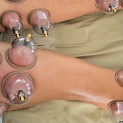Terapia de ventosas en las piernas
